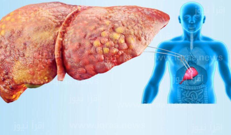 أعراض الكبد الدهني وطرق الوقاية منه